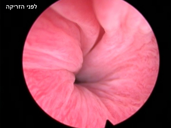 צינורית שופכה לפני הזרקת חומר תופס נפח