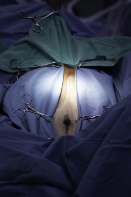 הסרת טבור מזוהם